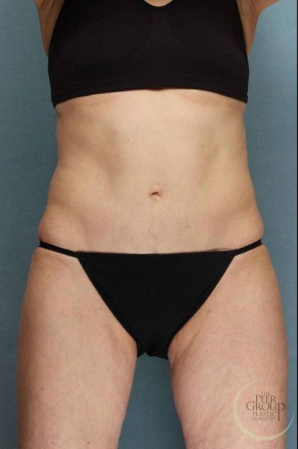 Tummy Tuck Before & After Patient #9157