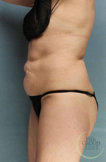 Tummy Tuck Before & After Patient #9157