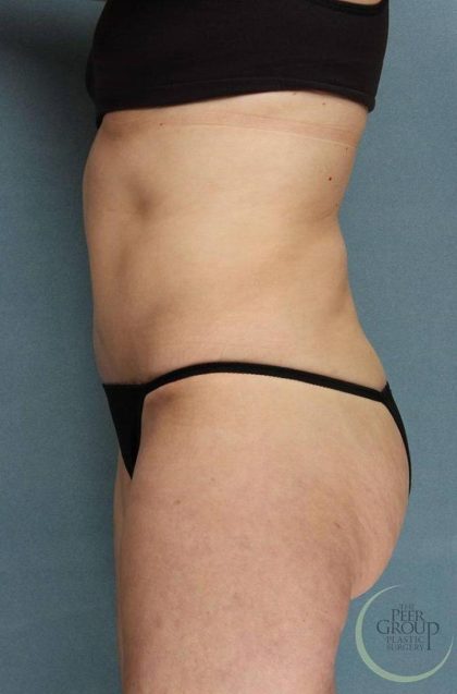 Tummy Tuck Before & After Patient #9157