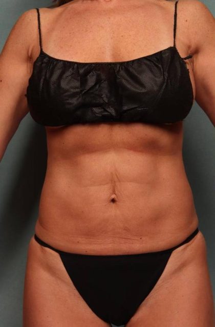 Tummy Tuck Before & After Patient #9136