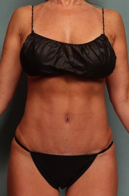 Tummy Tuck Before & After Patient #9136