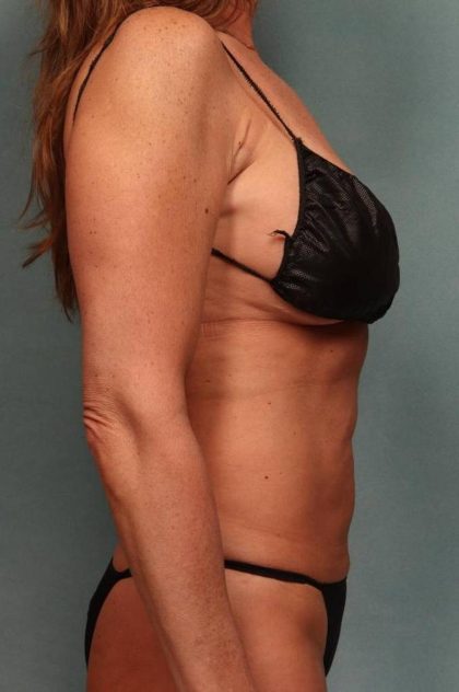 Tummy Tuck Before & After Patient #9136