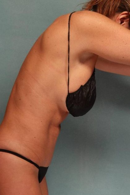 Tummy Tuck Before & After Patient #9136