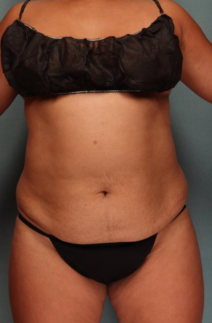 Tummy Tuck Before & After Patient #9137