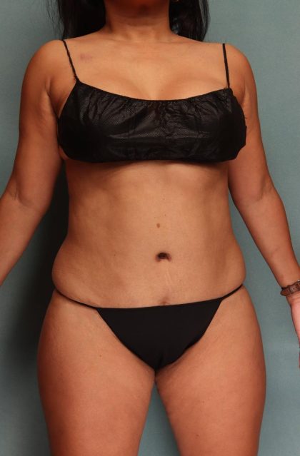 Tummy Tuck Before & After Patient #9137