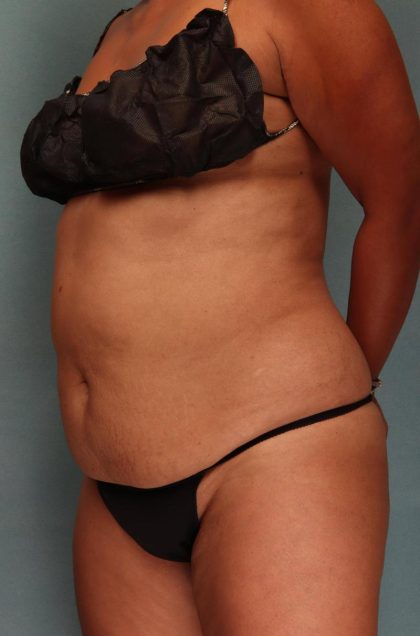 Tummy Tuck Before & After Patient #9137