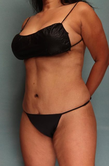 Tummy Tuck Before & After Patient #9137