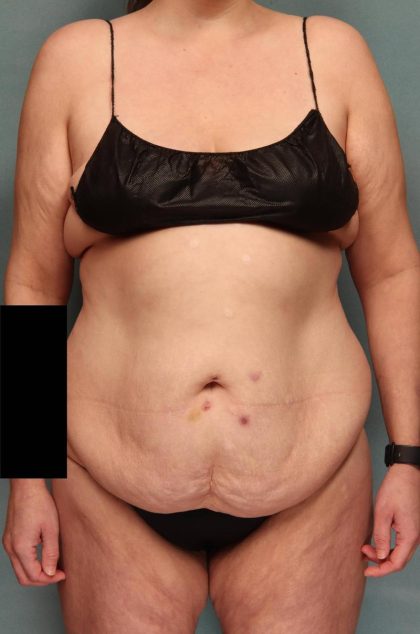 Tummy Tuck Before & After Patient #9138
