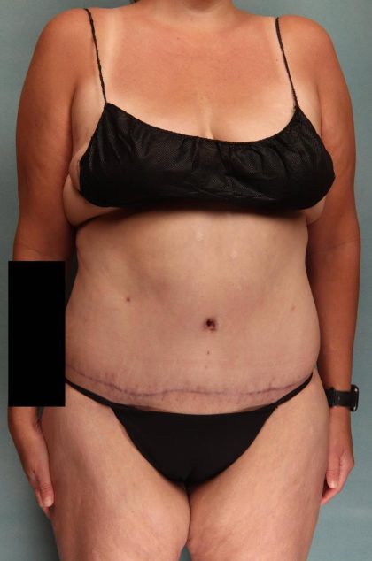 Tummy Tuck Before & After Patient #9138