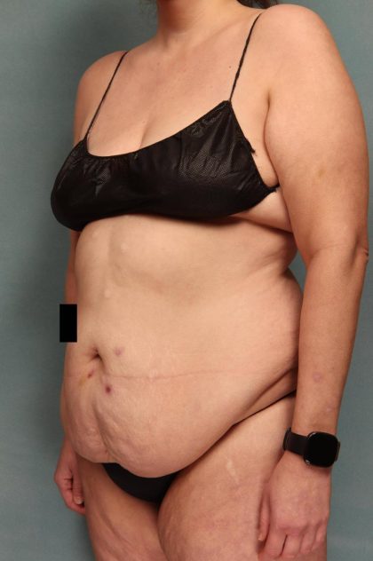 Tummy Tuck Before & After Patient #9138