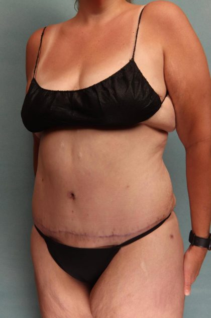 Tummy Tuck Before & After Patient #9138