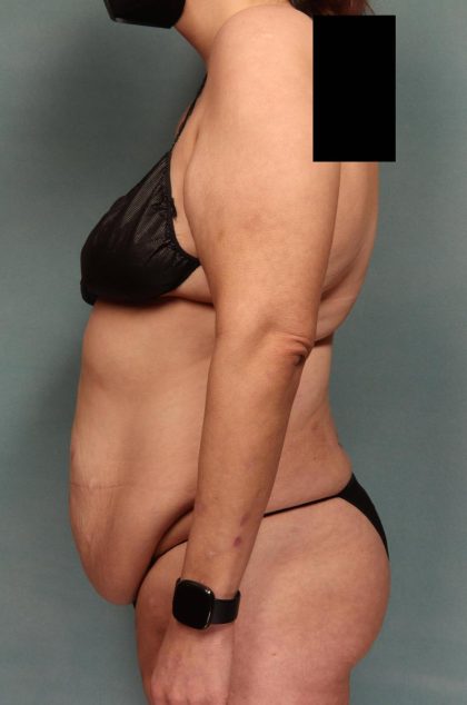Tummy Tuck Before & After Patient #9138
