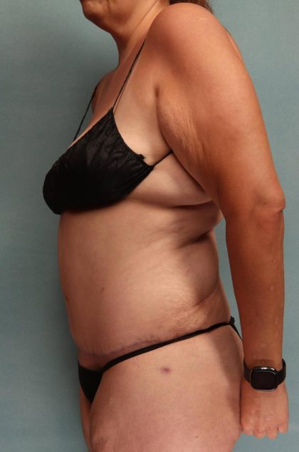 Tummy Tuck Before & After Patient #9138