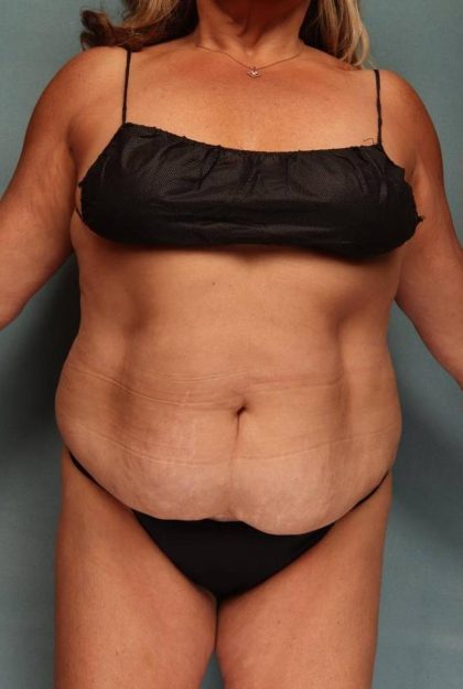 Tummy Tuck Before & After Patient #9139