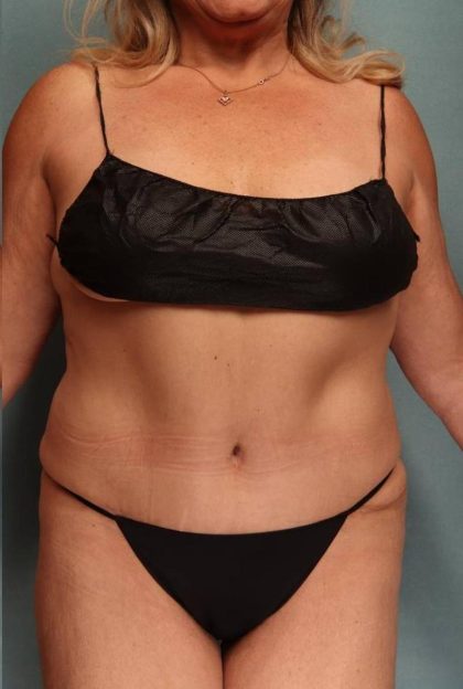 Tummy Tuck Before & After Patient #9139