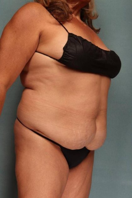 Tummy Tuck Before & After Patient #9139