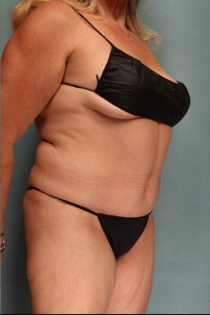 Tummy Tuck Before & After Patient #9139
