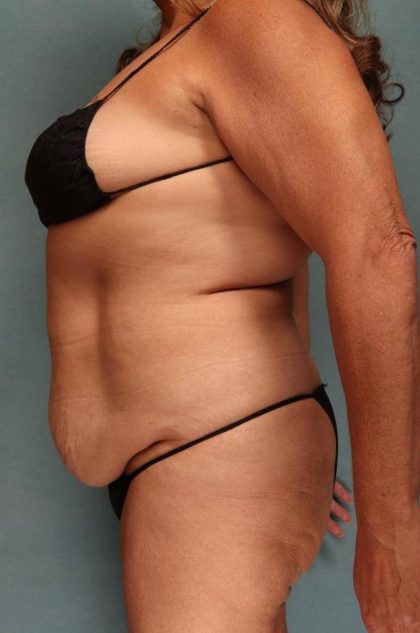 Tummy Tuck Before & After Patient #9139