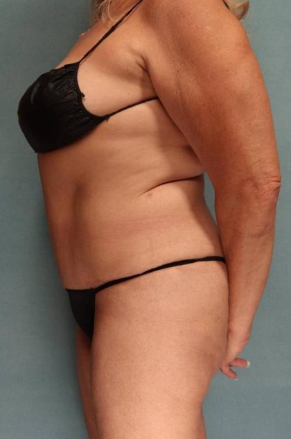 Tummy Tuck Before & After Patient #9139