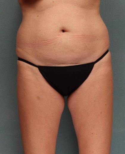 Tummy Tuck Before & After Patient #9141