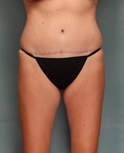 Tummy Tuck Before & After Patient #9141