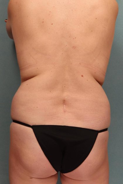 Tummy Tuck Before & After Patient #9141