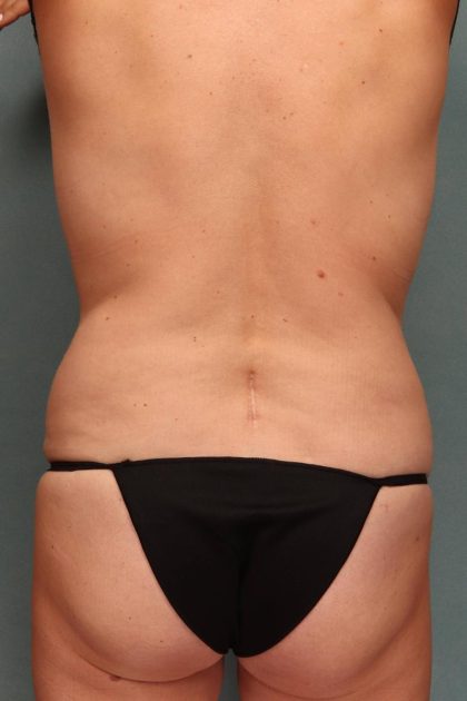 Tummy Tuck Before & After Patient #9141