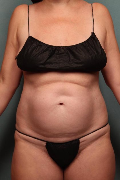 Tummy Tuck Before & After Patient #9142