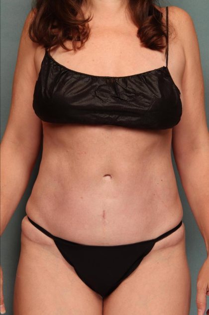 Tummy Tuck Before & After Patient #9142