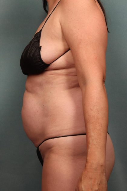 Tummy Tuck Before & After Patient #9142