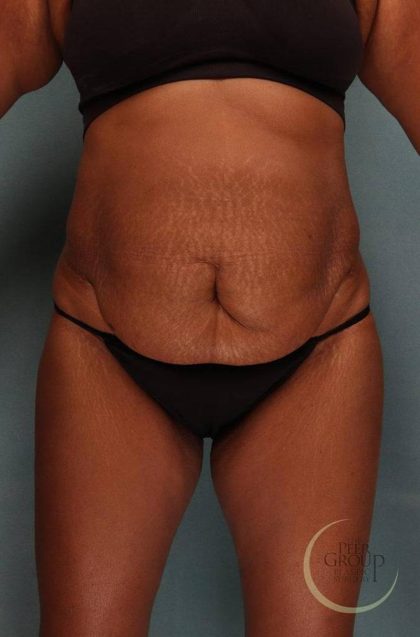 Tummy Tuck Before & After Patient #9143