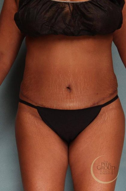 Tummy Tuck Before & After Patient #9143