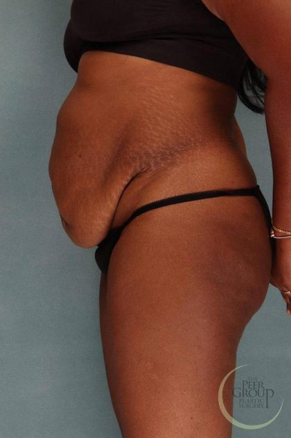 Tummy Tuck Before & After Patient #9143
