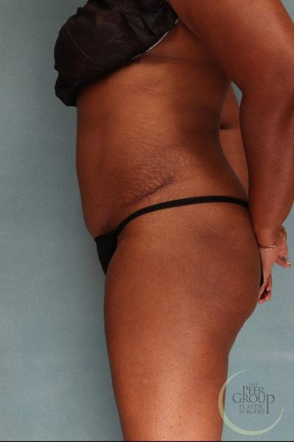 Tummy Tuck Before & After Patient #9143