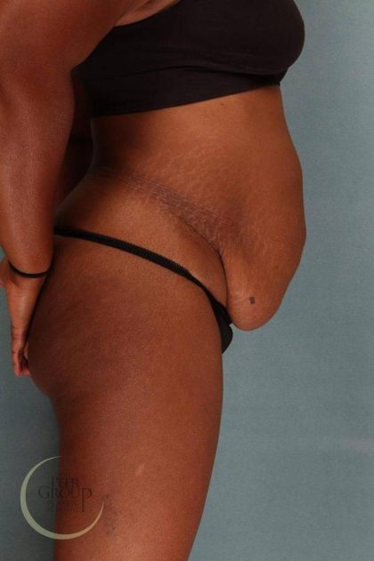 Tummy Tuck Before & After Patient #9143