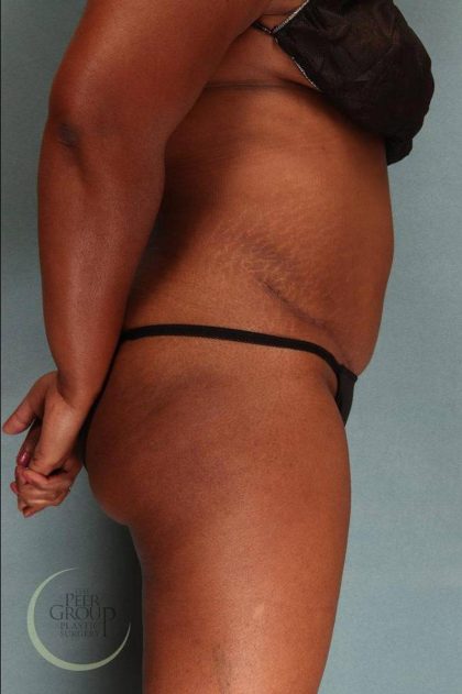 Tummy Tuck Before & After Patient #9143