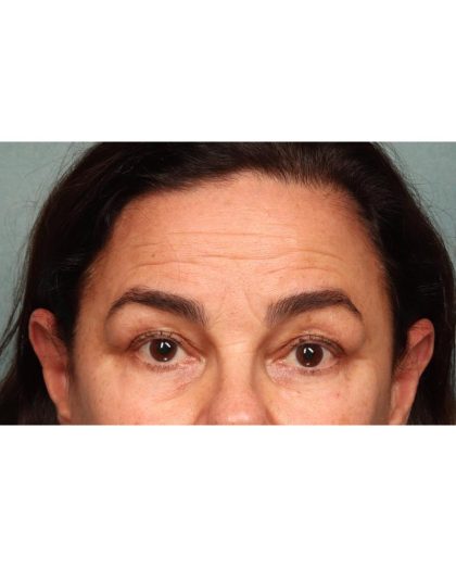 Blepharoplasty Before & After Patient #9064