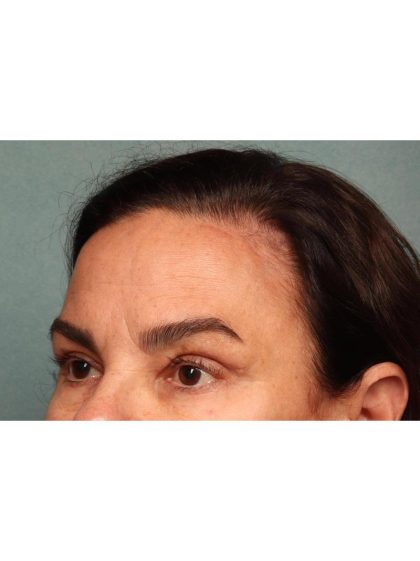 Blepharoplasty Before & After Patient #9064