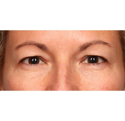 Blepharoplasty Before & After Patient #9025