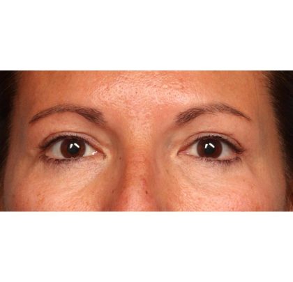 Blepharoplasty Before & After Patient #9025