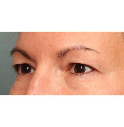Blepharoplasty Before & After Patient #9025