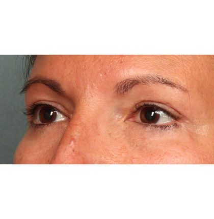 Blepharoplasty Before & After Patient #9025