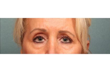 Blepharoplasty Before & After Patient #9024