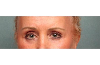 Blepharoplasty Before & After Patient #9024