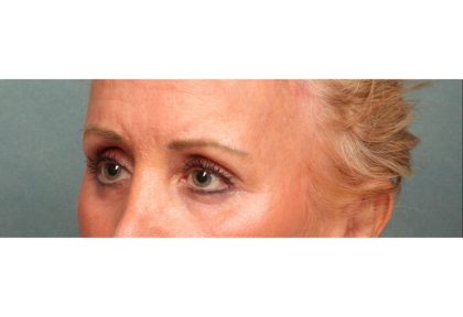 Blepharoplasty Before & After Patient #9024