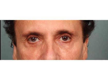 Blepharoplasty Before & After Patient #9023