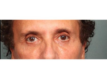 Blepharoplasty Before & After Patient #9023