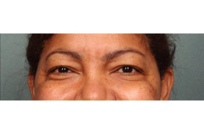 Blepharoplasty Before & After Patient #9018