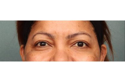 Blepharoplasty Before & After Patient #9018