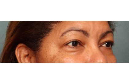Blepharoplasty Before & After Patient #9018
